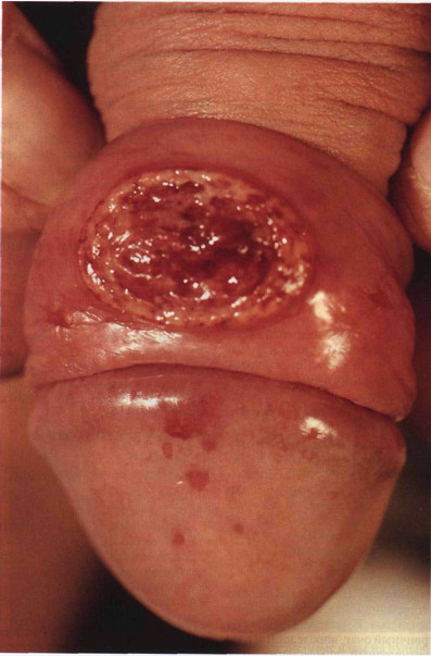  проявления инфекции Haemophilus ducreyi