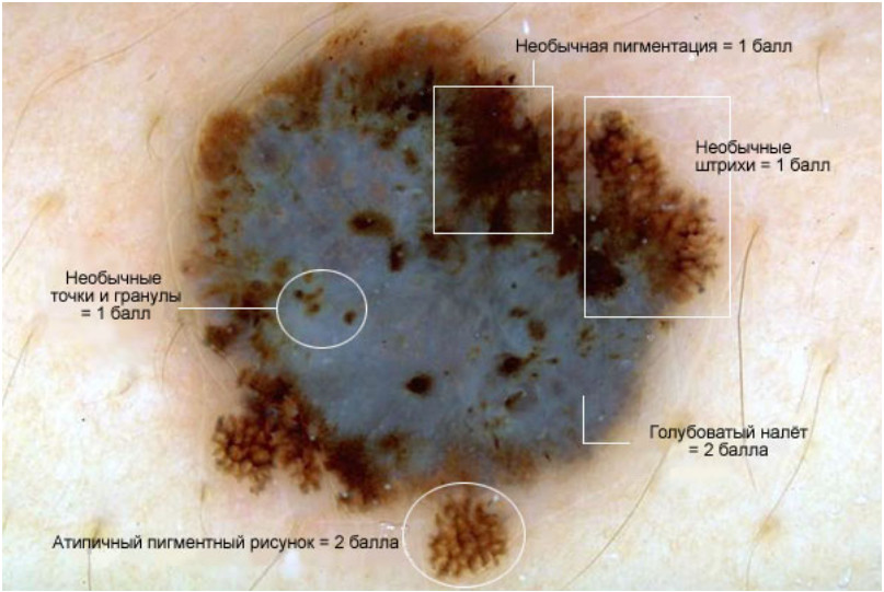 Изображение меланомы в дерматоскопе