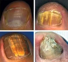 OНИХОМИКОЗЫ грибковые инфекции ногтей