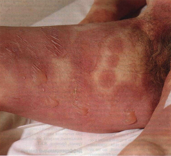 Лекарственная аллергия синдром стивенс джонсона thumbnail