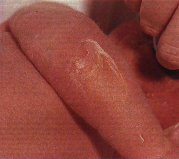 Синдром ошпаренной кожи у ребенка thumbnail